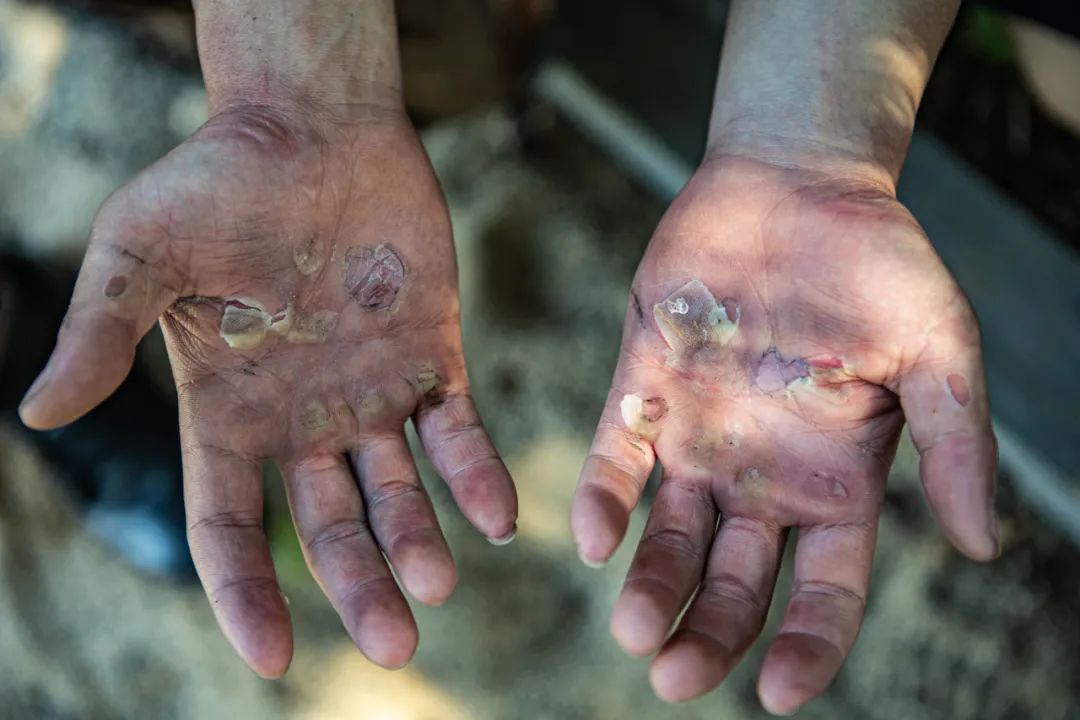 拉完单杠后的双手