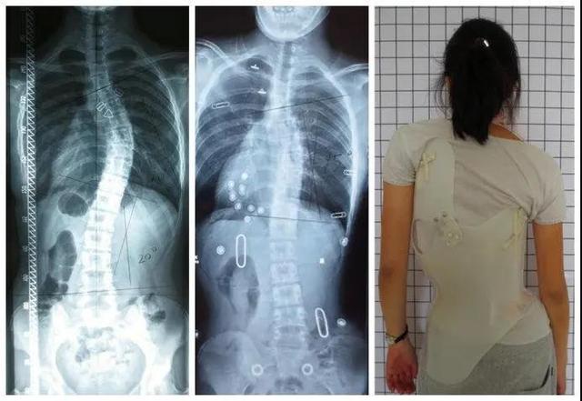 高低肩,弯腰驼背?可能是脊柱侧弯!松江这个专病门诊开诊啦