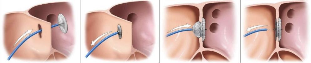 经皮房间隔缺损介入封堵术为心脏上的破洞撑起一把遮风挡雨的小伞