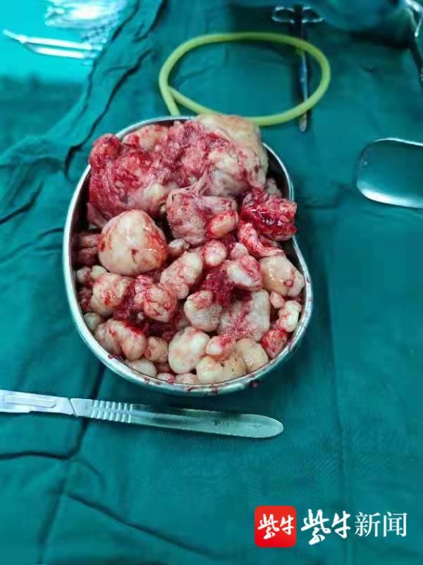 女子腹部大如怀孕5个月,结果挖出89枚子宫肌瘤