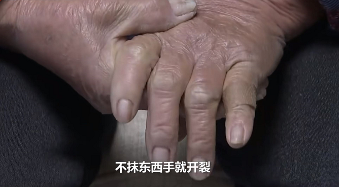 ·丛慧玉的双手干裂。