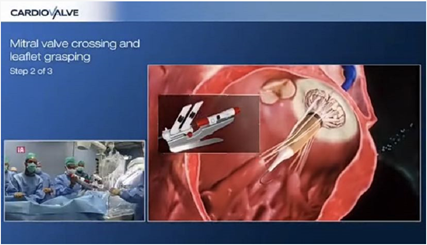 图片来源：Cardiovalve系统可同时用于二尖瓣及三尖瓣置换（视频截图）