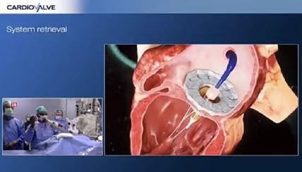 图片来源：Cardiovalve系统可同时用于二尖瓣及三尖瓣置换（视频截图）