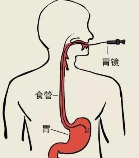 咽炎和食道癌到底如何区分听专家讲解