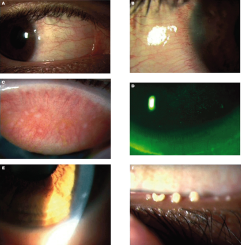 为什么美国的医疗器械注册叫做510k全球首例角膜接触镜高效除蛋白设备——3N隐形眼镜还原仪已通过FDA 510K认证_https://www.jmylbn.com_新闻资讯_第3张