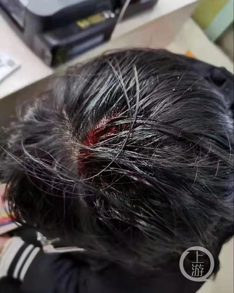 佳佳头部被鹅卵石砸伤.图片来源/上游新闻记者 胡磊