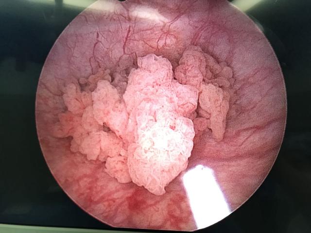 免疫治疗取得肿瘤完全控制(cr)的良好效果,避免了一次膀胱全切的手
