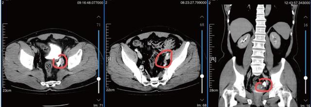 高度恶性膀胱癌患者还有保留膀胱的希望吗
