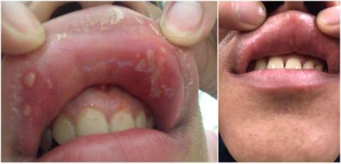 口腔溃疡反复发作是缺维生素了你可能一直都错了改善口腔疾病这个方法