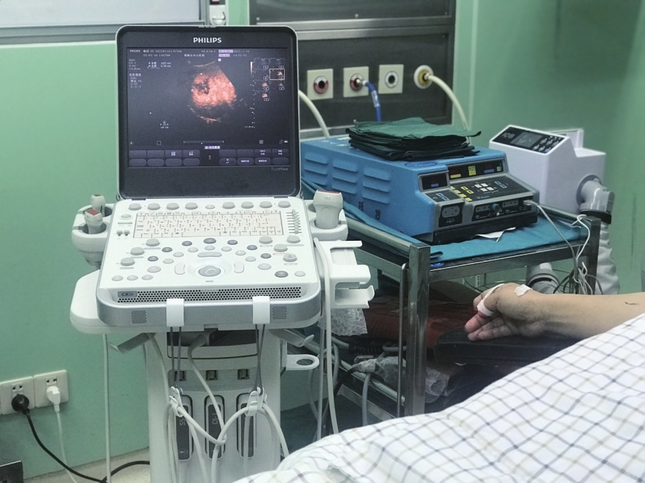 记床旁超声实时声学造影辅助外科肿瘤消融近日,市中心医院超声