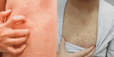 螨虫，是很可怕的一个过过敏源