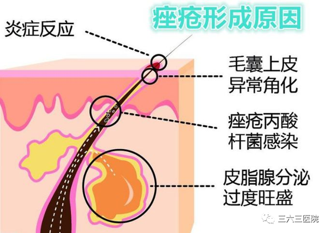 "来势汹汹"的春季痘痘不要怕 三六三医院皮肤科教