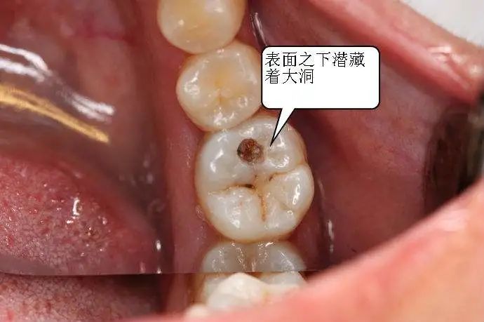 医生告诉我们:「拖得太久了,后槽牙的牙根已经被蛀牙细菌啃噬空了,都