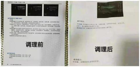 每2个人中就有1人患有甲状腺疾病及时调理是关键中医