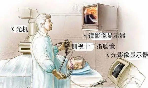 通过内镜经口-食道-胃,抵达十二指肠乳头开口处,顺利进入胆总管