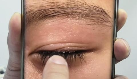 睫毛的根部与睫毛的上面医生经检查发现妈妈立刻把他带到医院导致胶水