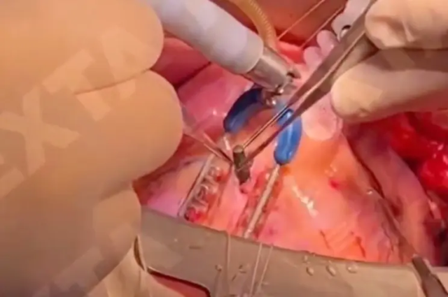 惊险画面曝光:手术医生从乌克兰士兵跳动的心脏中取出子弹|白俄罗斯_