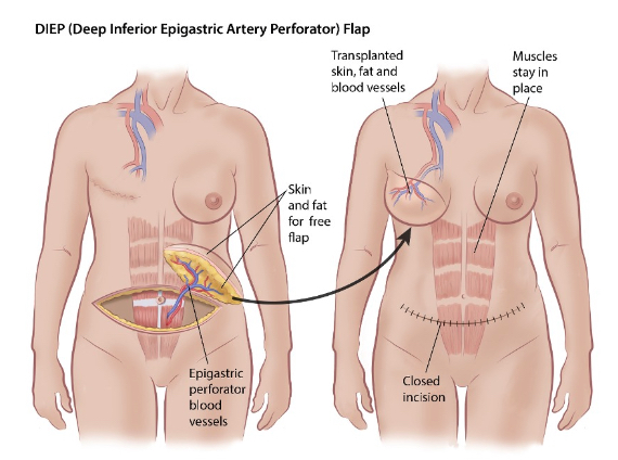 狼肚子怎么切为了给我造个“C杯”，医生“拆”下了我肚子的肥肉_https://www.jmylbn.com_新闻资讯_第6张