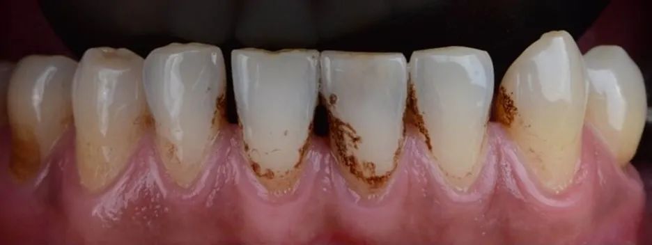 色素沉着除了龋齿,牙齿上的小黑点还有一种可能性——不爱刷牙,不经常