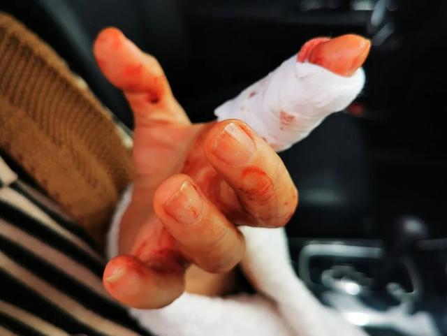 刀伤及骨急诊骨科紧急救治挽回患者手指