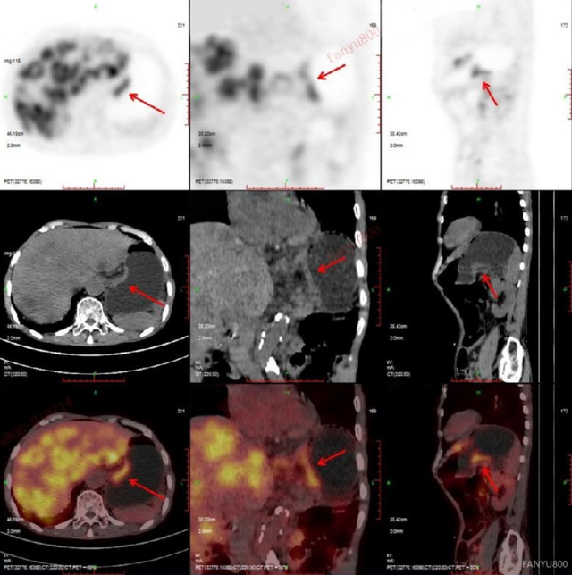 petct真是神器癌症领域的福尔摩斯