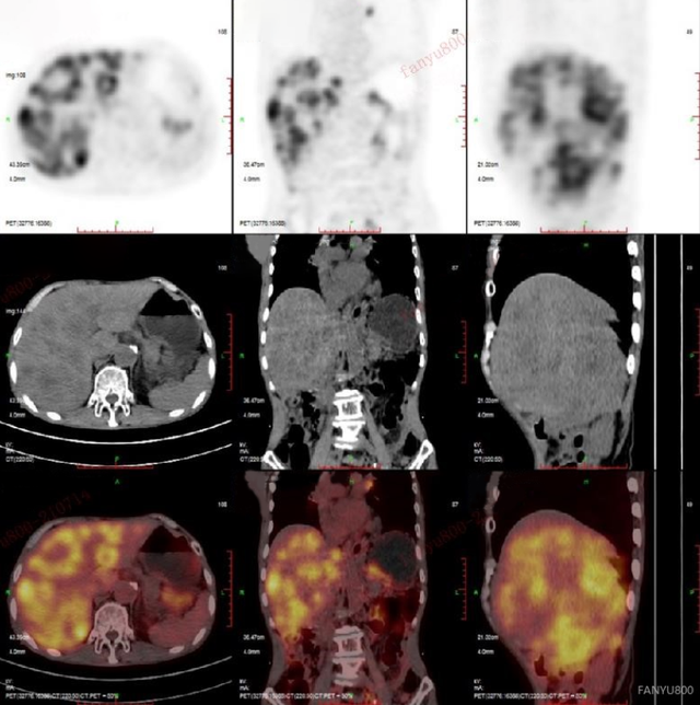 petct真是神器癌症领域的福尔摩斯