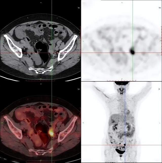 腹膜后多发淋巴结fdg代谢增高,考虑:卵巢癌(源于左侧卵巢可能性大)并