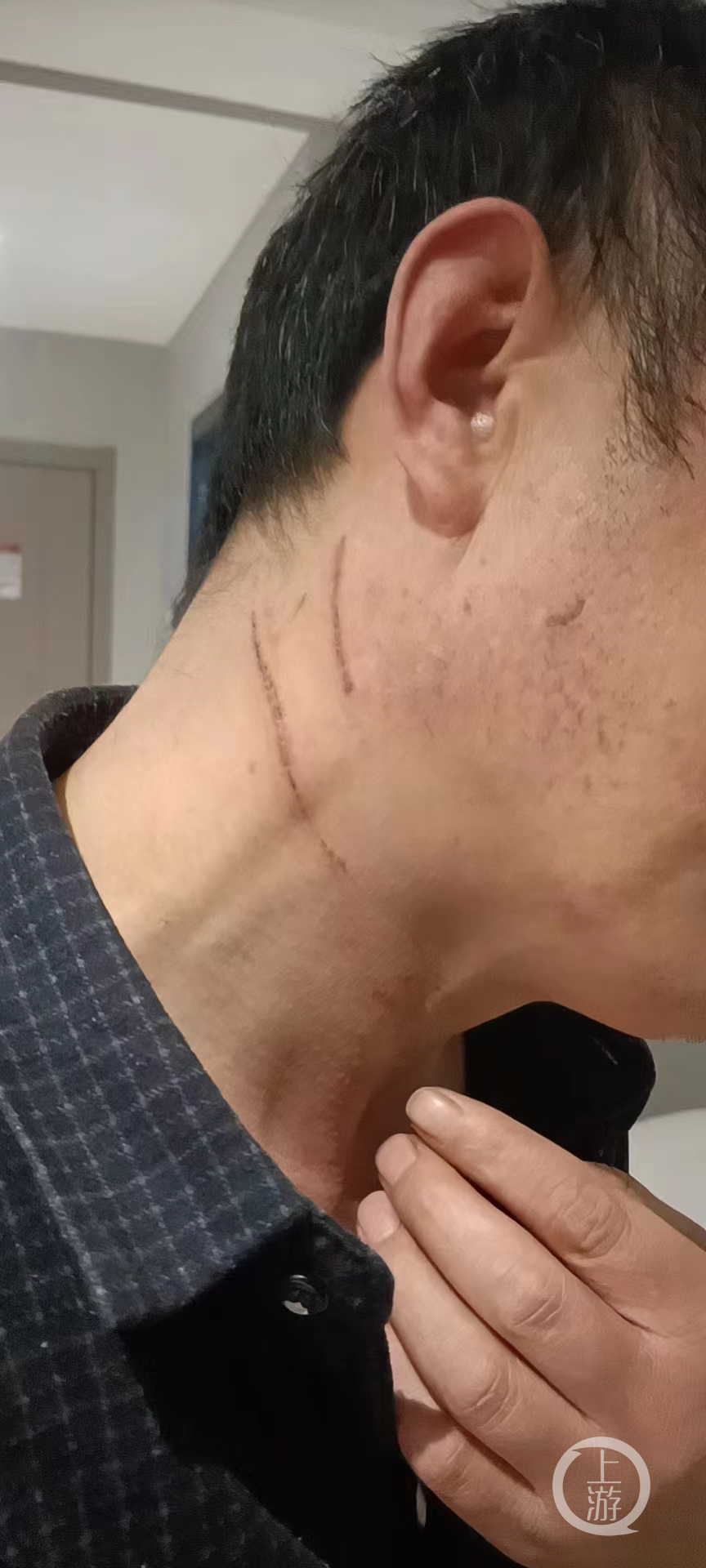 王战省脖子被抓伤.图片来源/受访者供图