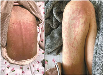 45小时后慈溪女孩终于住进医院