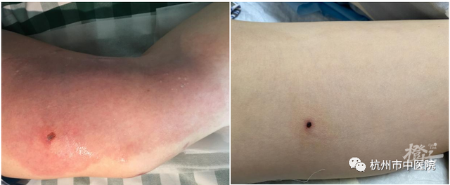 杭州50多岁阿姨大腿惊现红斑水疱竟是被它咬伤这种虫子专爱咬人大腿