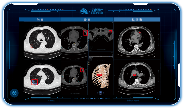 　　▲Dr.Wise®胸部CT AI医学辅助诊断系统