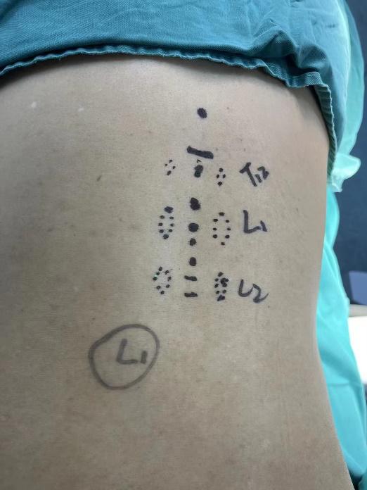 脊柱微创手术有多优秀患者术后一周即出院