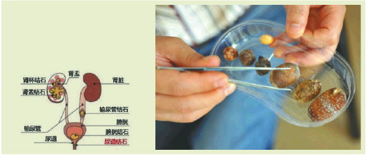 不痛的结石更可怕