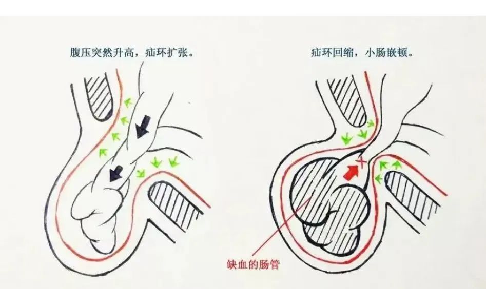 为右侧腹股沟疝嵌顿导致完全性小肠梗阻,有肠管绞窄缺血坏死可能