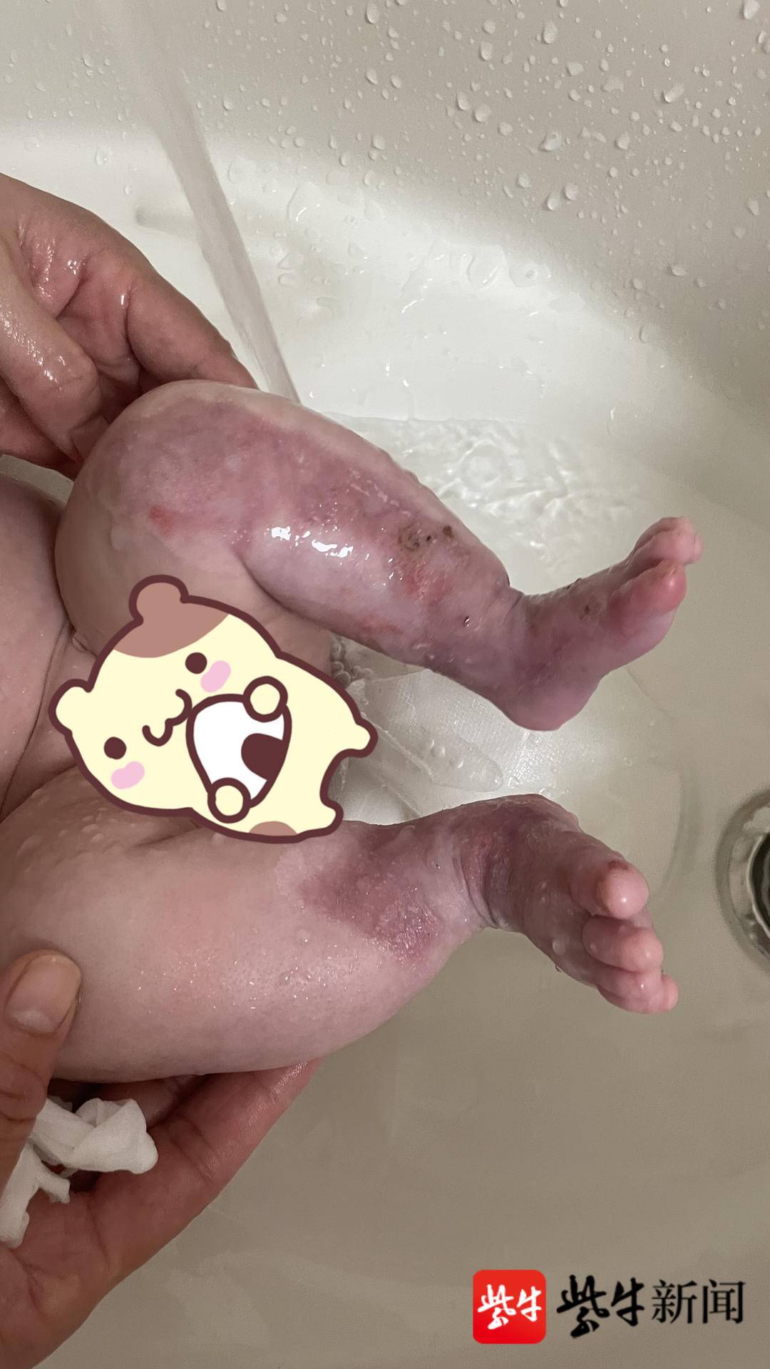 发病率十万分之一宝宝出生小腿却没皮肤