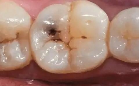 栓塞,不要自行清理,可到耳鼻咽喉科就诊,通过滴耳液进行几天的软化后