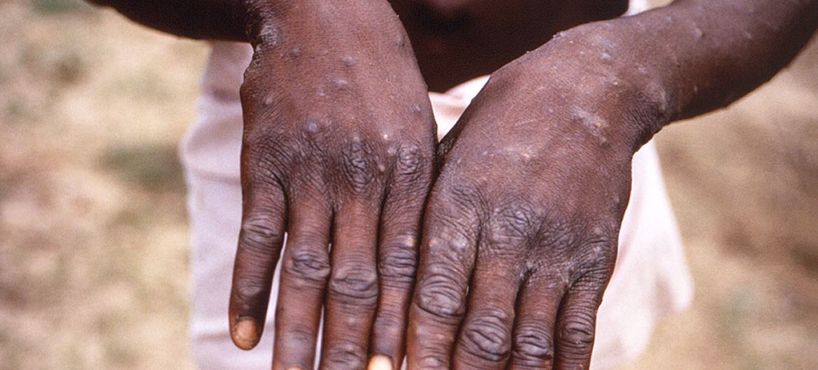 刚果的猴痘患者 图片来源：联合国