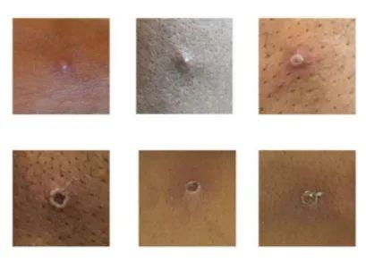 猴痘患者皮肤表面出现的症状（图片来源：英国卫生安全局） 