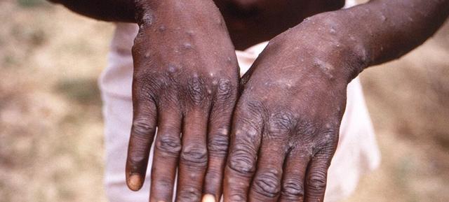 ▲刚果共和国，美国疾病控制与预防中心提供的图像显示一位猴痘患者手部。图片来源：世卫组织官网截图
