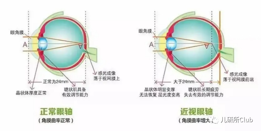 图1 近视原理图