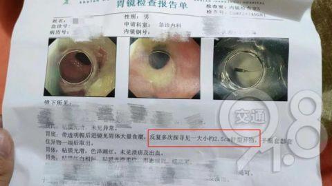 杭州男子看牙,近3厘米长的针滑进胃里|医院_新浪财经_新浪网