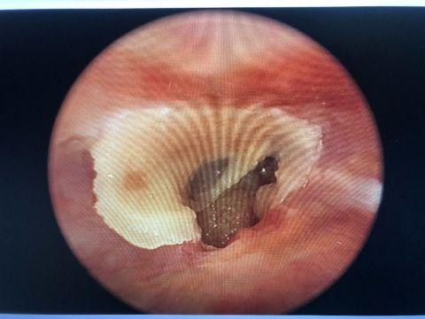 外耳道深处有白色固体,已经与外耳道皮肤紧紧黏附,左耳鼓膜已经穿孔