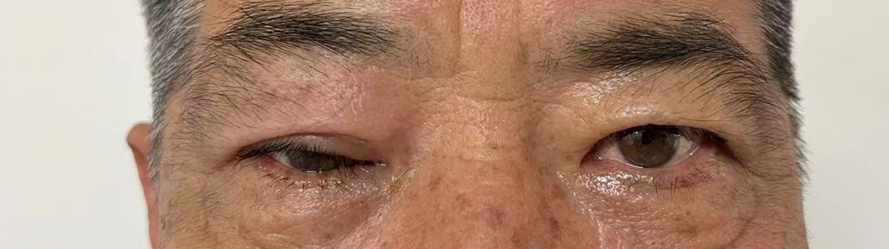 普瑞眼科成功为患者完成高难度眼眶肿瘤手术