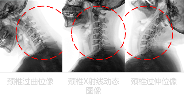 　　(左侧静态悬吊DR拍摄 右侧悬吊动态DR拍摄)