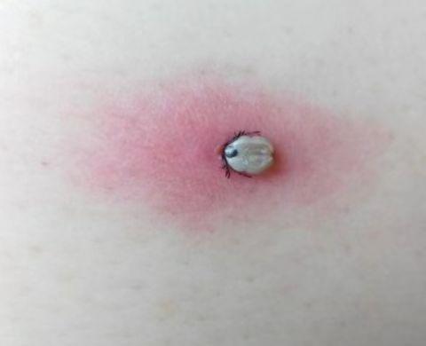 (扎入皮肤之后,吸血的蜱虫变成肤色.受访者供图)