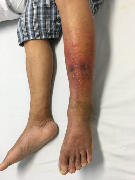 医生诊断,他患上了常见的皮肤疾病——丹毒.