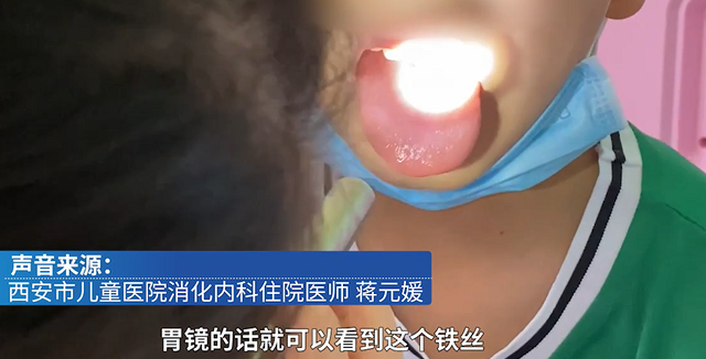 蒋医生表示,(在胃里)取铁丝还是第一次遇到,之前只取过针灸针,串联的