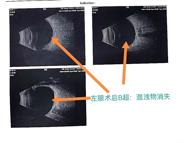 二十多岁也会得飞蚊症吗?听听眼底病张思伟医生怎么说