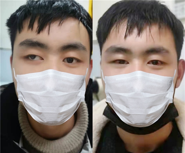 斜视手术案例摆脱斜视阴霾正视开启新的人生旅程