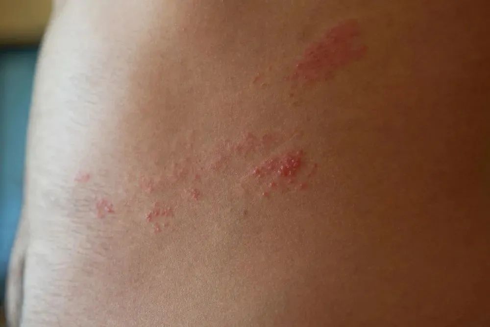 "蛇缠腰"比生孩子还痛!别让它盯上咱爸妈